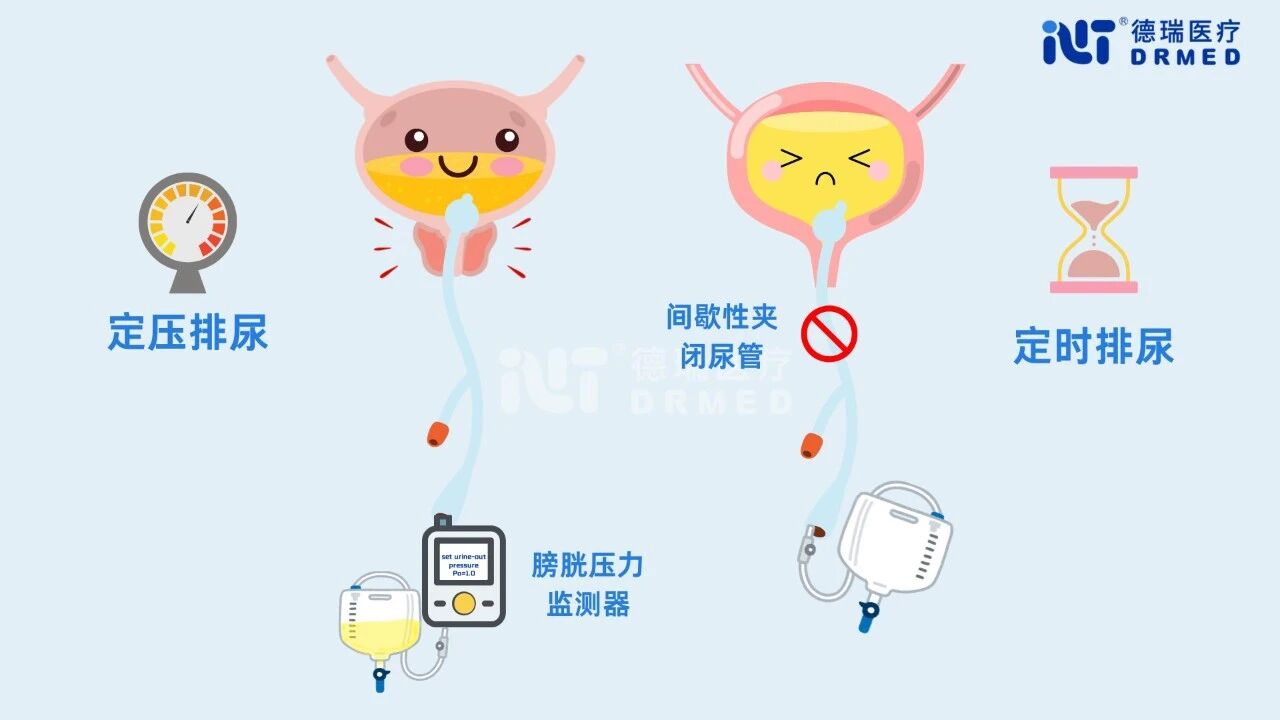 新品速递 | 留置导尿期间膀胱功能训练新方法